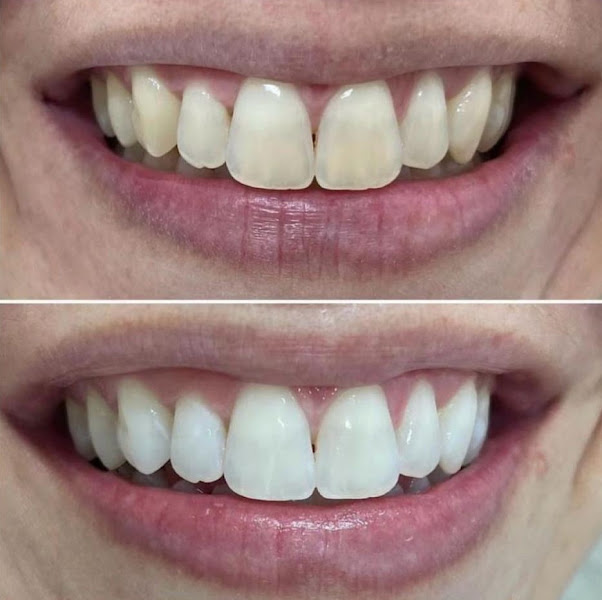 Foto 3 de Dra. Luciana Machiavelli | Ortodontista | Clareamento Dental