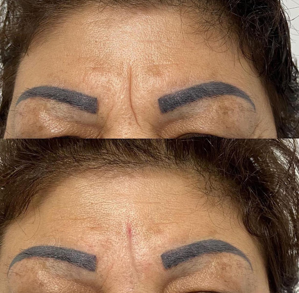 Foto 3 de Dra Luciana Tchaick | Harmonização Facial | Preenchimento Labial Caxias do Sul | Toxina Botulínica