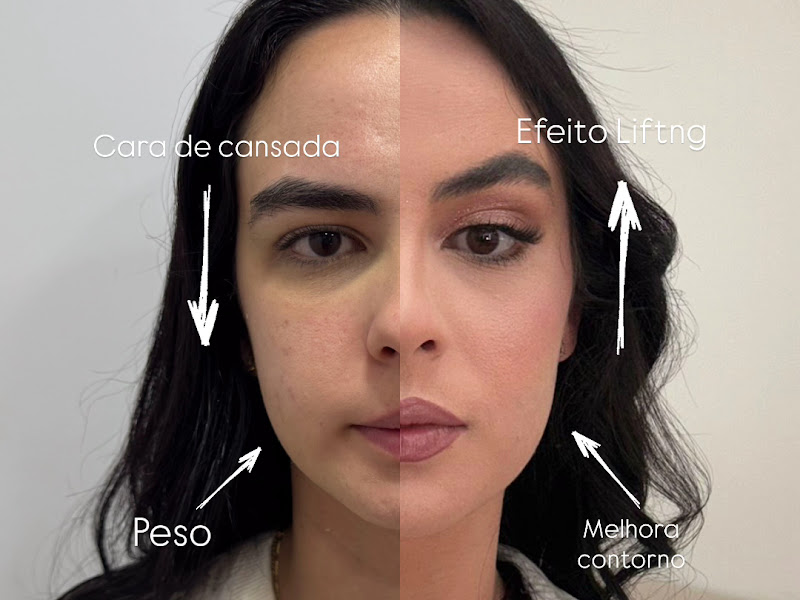 Foto 2 de Dra. Luciene Martins - Harmonização Orofacial