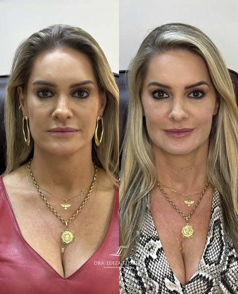 Foto 2 de Dra. Luiza Teixeira Harmonização Facial