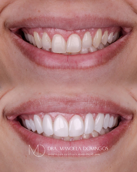 Foto 2 de Dra Manoela Domingos - Lentes de Resina e Implantes Dentários