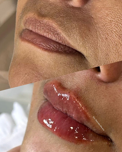 Foto 2 de Dra. Manuella Macena - Harmonização Facial