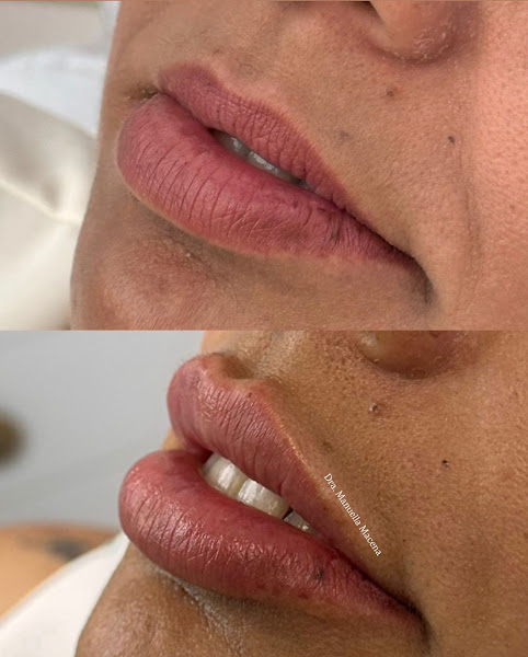 Foto 3 de Dra. Manuella Macena - Harmonização Facial