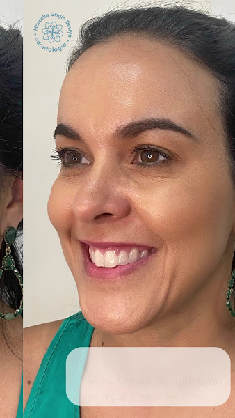 Foto 3 de Dra. Marcella Grigio Dewyn | Harmonização Facial | Preenchimento | Toxina Botulínica