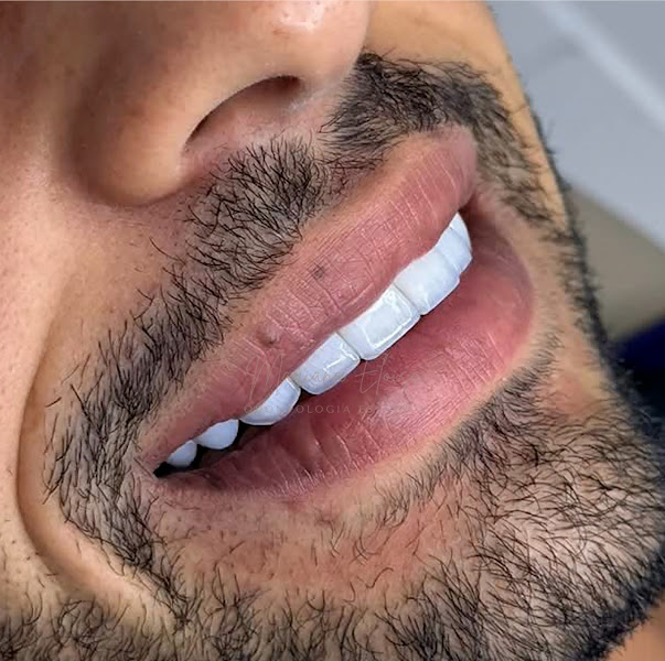 Foto 2 de Dra. Mariana Eloisa | Facetas em Resina