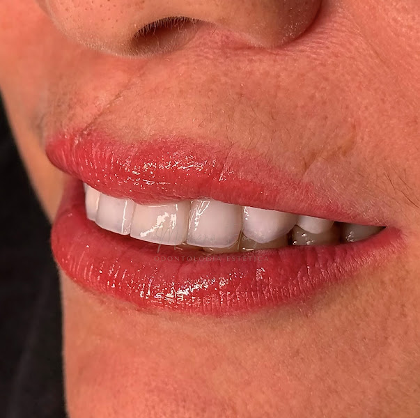 Foto 3 de Dra. Mariana Eloisa | Facetas em Resina