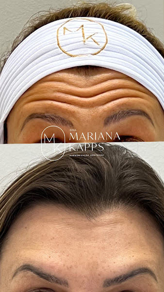 Foto 3 de Dra. Mariana Kapps | Harmonização Facial