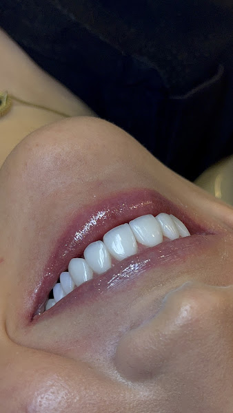 Foto 3 de Dra. Marilia Karolyne - Lentes em Resina