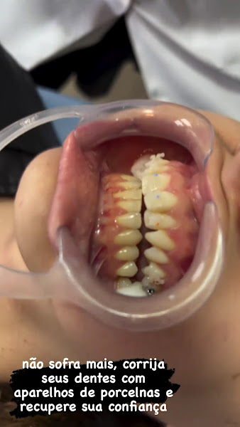 Foto 3 de Dra Melissa Nalifico | Dentista em Colombo | Aparelho ortodôntico
