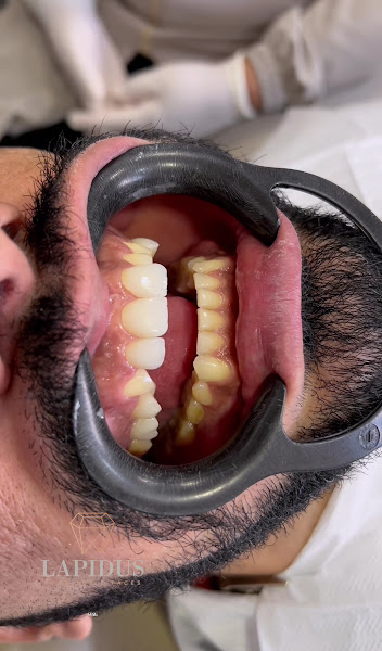 Foto 4 de Dra. Michelle Cavalcante | Lentes de Contato Dental | Implante Dentário | Dentista em Maceió