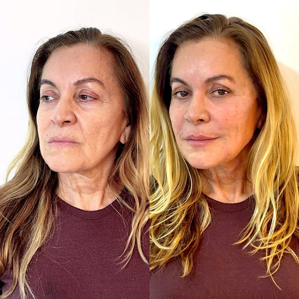 Foto 3 de Dra. Michelline Godeiro | Harmonização Facial em Recife