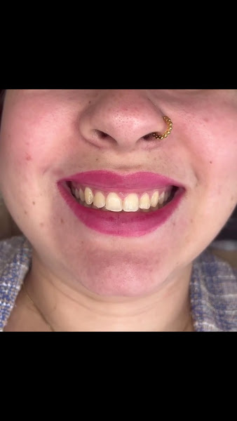 Foto 3 de Dra. Michelly Kuzminskas | Dentista | Facetas de Resina | SJC