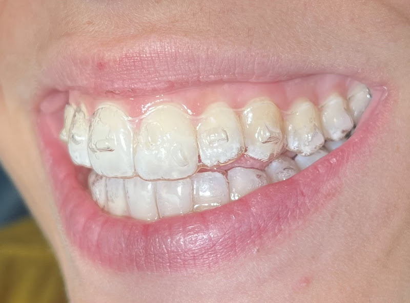 Foto 3 de Dra. Milena Mota - Cirurgia Bucomaxilofacial/ DTM e Dor Orofaciais/Harmonização Orofacial/Invisalign