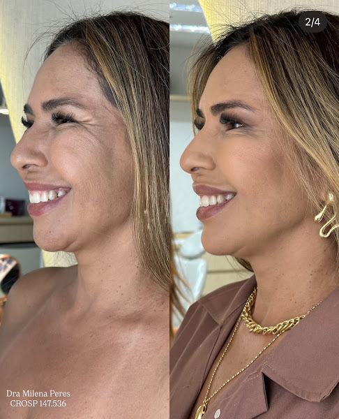 Foto 3 de Dra Milena Peres - Harmonização Facial