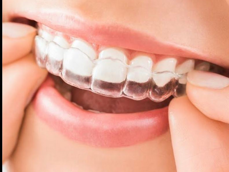 Foto 2 de Dra. Mônica Casimiro Ortodontia Alinhadores Harmonização Facial