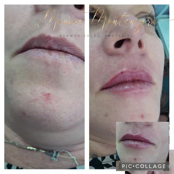 Foto 3 de Dra Mônica Montenegro | Especialista em Harmonização Facial CRO9654 DF