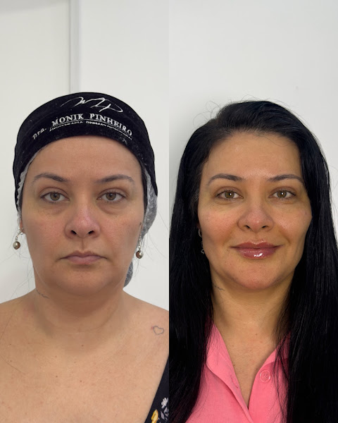 Foto 2 de Dra. Monik Pinheiro - Harmonização Facial em Taboão da Serra