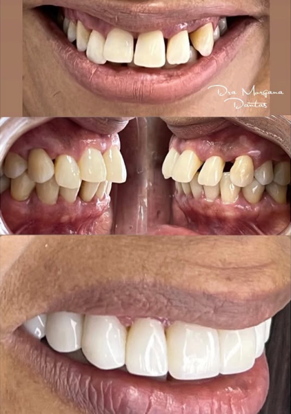 Foto 3 de Dra. Morgana Dantas / Rennovare - Facetas de Resina em Juazeiro do Norte | Dentista em Juazeiro do Norte