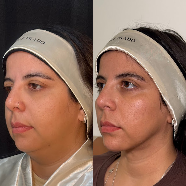 Foto 2 de Dra. Mychelle Prado | Lipo de Papada | Harmonização Facial | Cirurgias Estéticas Faciais