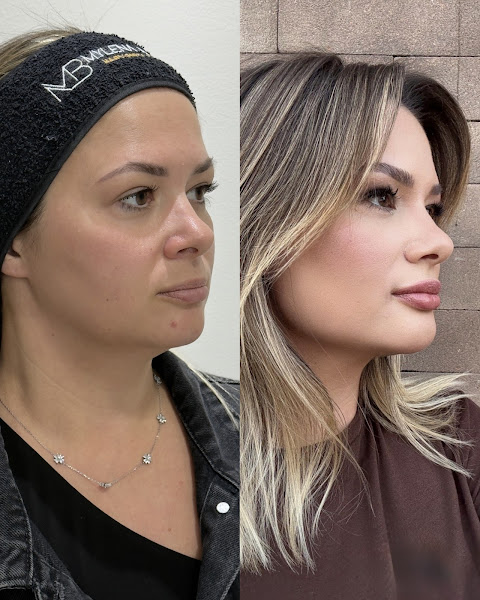 Foto 3 de Dra Mylena Berner Harmonização Facial - Alphaville