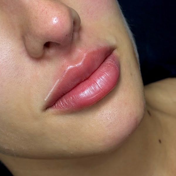 Foto 3 de Dra Mylena Coutinho - Harmonização Orofacial