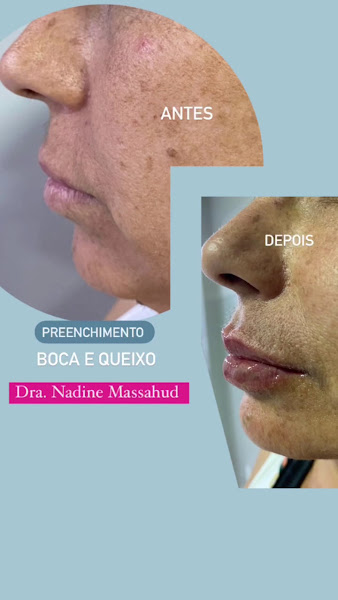Foto de Dra. Nadine Massahud HARMONIZAÇÃO OROFACIAL - Botox, Preenchimentos e bioestimuladores