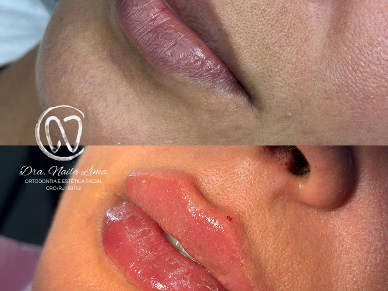 Foto 3 de Dra Naila Lima | Lipo Cervico Facial