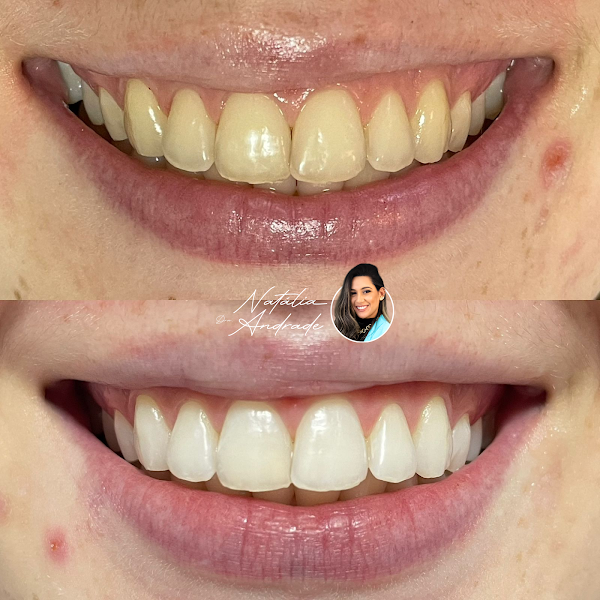 Foto 3 de Dra Natália Andrade | Facetas de Resina Gurupi - TO