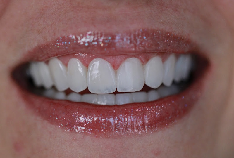 Foto 2 de Dra Patricia Lopes - Lentes de resina e Odontologia Estética