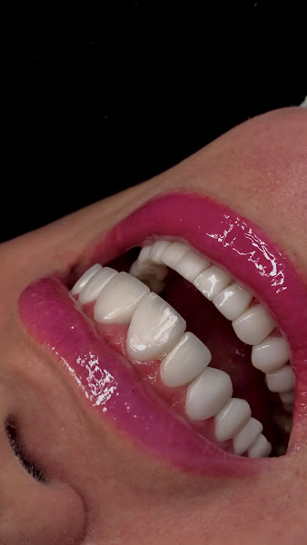 Foto 3 de Dra Patricia Lopes - Lentes de resina e Odontologia Estética