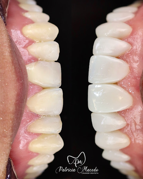 Foto 3 de Dra. Patrícia Macedo - Lentes e Facetas de Resina | Recife-PE