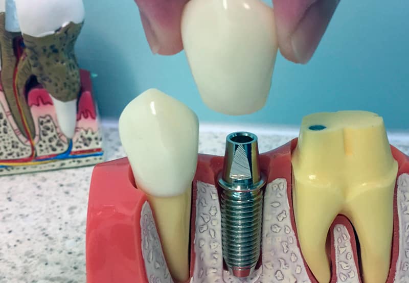 Foto 3 de Dra. Paulina Becker | Clínica Odontológica Especializada em Implantes Dentários