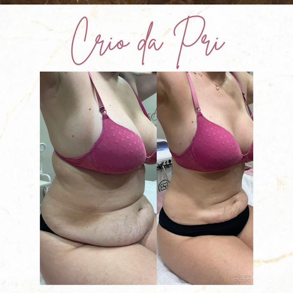 Foto 2 de Dra.Priscila Duarte - Fisio Dermatofuncional: Estética Facial/ Corporal e Pós-Operatório de Cirurgia Plástica.
