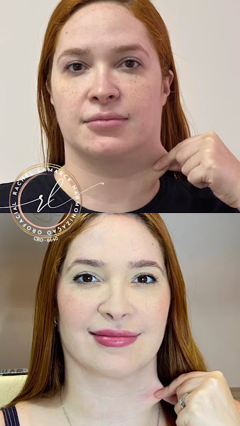 Foto 3 de Dra. Rachel Lamarck - Consultório de Harmonização Facial, Odontologia e Estética em Imperatriz - Botox, Preenchimento Labial