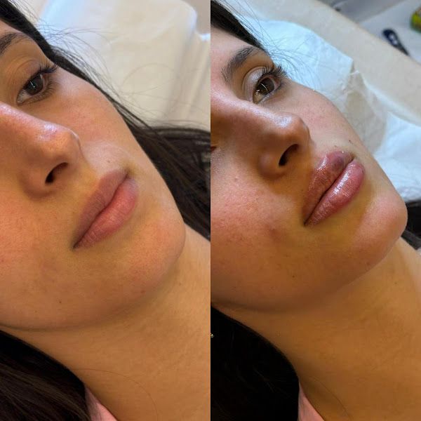 Foto 2 de Dra. Rafaella Freitas | Harmonização Facial e Cirurgiã-Dentista