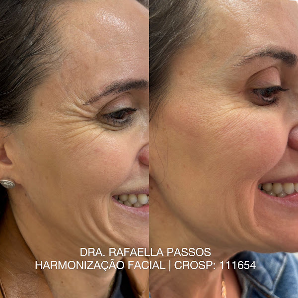 Foto 3 de Dra. Rafaella Passos - Harmonização Facial