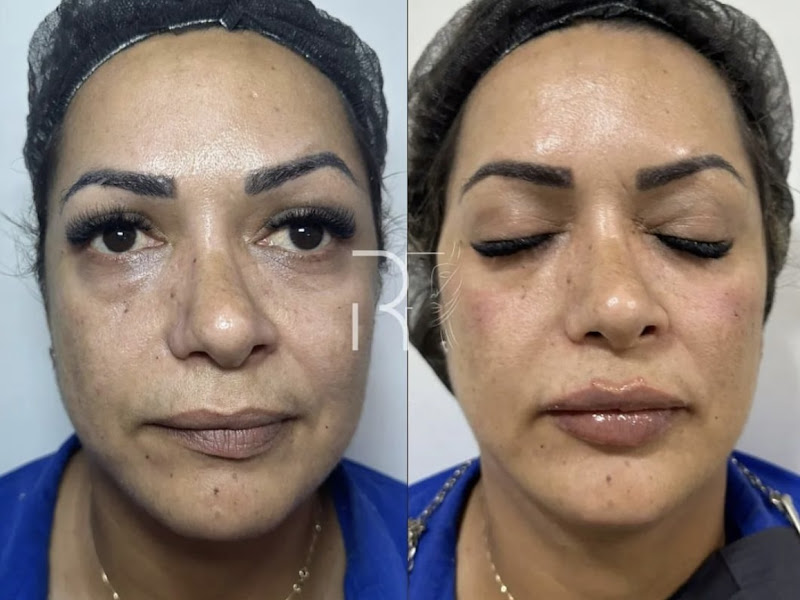 Foto 2 de Dra Raiana Felipe - Harmonização Orofacial