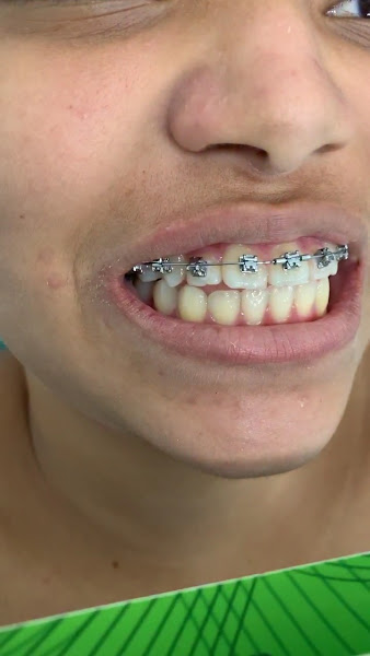 Foto 3 de Dra Raissa Lucena - Ortodontia Especializada