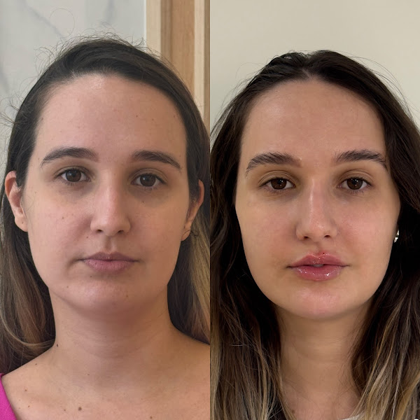 Foto 3 de DRA RENATA LOUREIRO - HARMONIZAÇÃO FACIAL