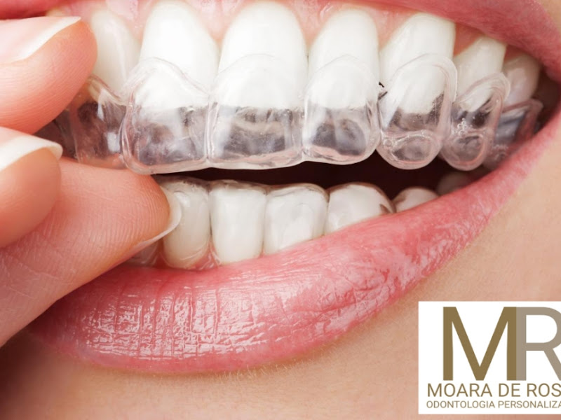 Foto 8 de Dra.Renata Madeira - Invisalign e Odontologia estética