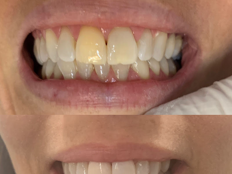 Foto 9 de Dra. Richelle Rodrigues (Dentista) Gengivoplastia . Tratamento Periodontal . Clareamento