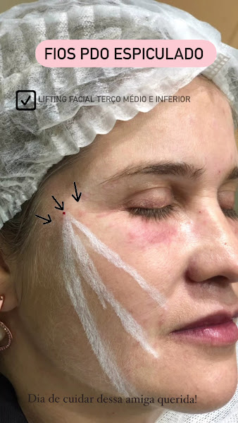 Foto 3 de Dra Sandra Maeta -Harmonização orofacial