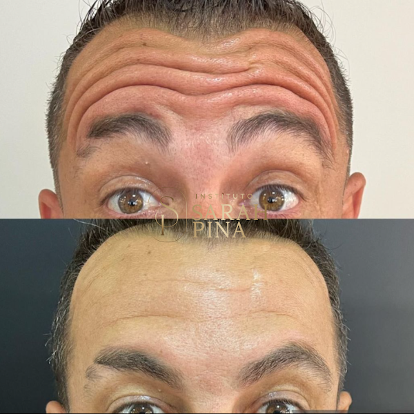 Foto 3 de Dra. Sarah Pina - Harmonização Facial Uberlandia - Preenchimento Labial - Botox - Rinomodelação ⭐