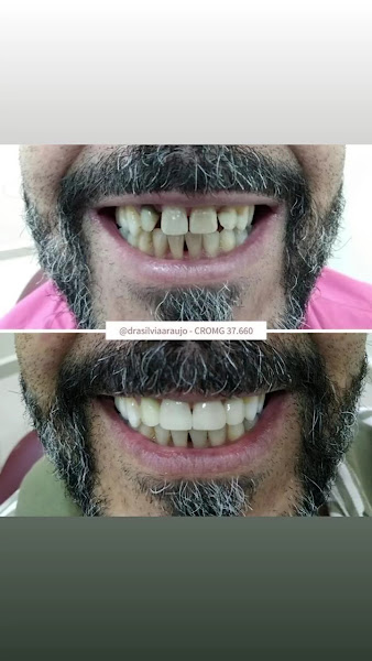 Foto 4 de Dra. Sílvia Araújo | Referência em Lentes de Contato Dental | Facetas em Resina
