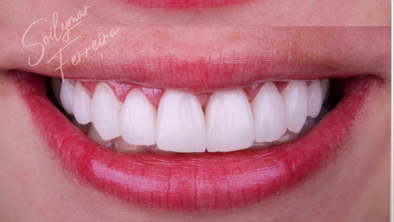 Foto 2 de Dra Sôilymar Ferreira Lentes em Resina e Implantodontia