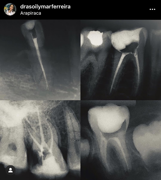 Foto 3 de Dra Sôilymar Ferreira Lentes em Resina e Implantodontia