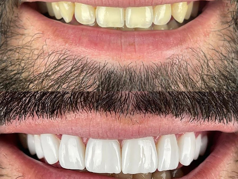 Foto 3 de Dra Stefani Farago l Lentes em Resina Rio de Janeiro l Barra da Tijuca