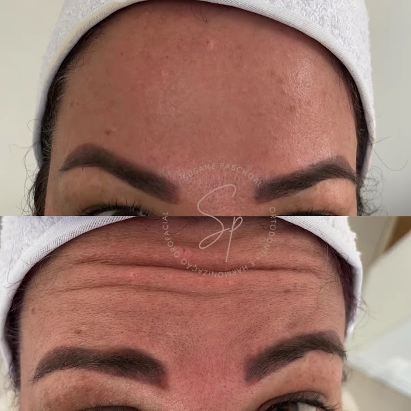 Foto 3 de Dra. Susane Paschoal - Dentista Petrópolis, Harmonização Facial, Ortodontia, Clareamento Dental