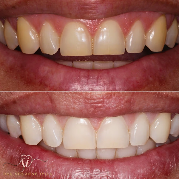 Foto 2 de Dra Suzanne Ivila Odontologia Estética