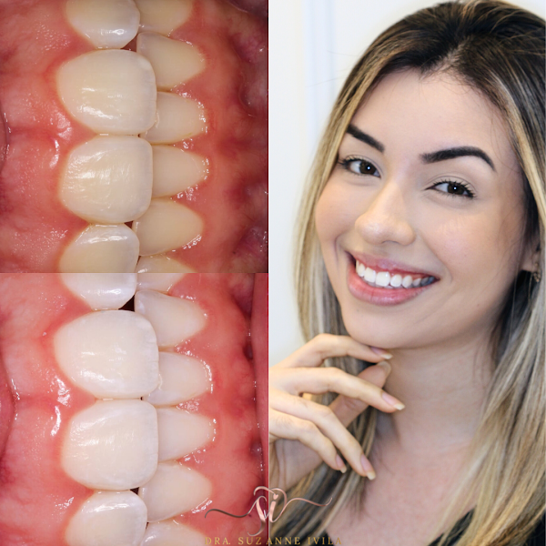 Foto 3 de Dra Suzanne Ivila Odontologia Estética
